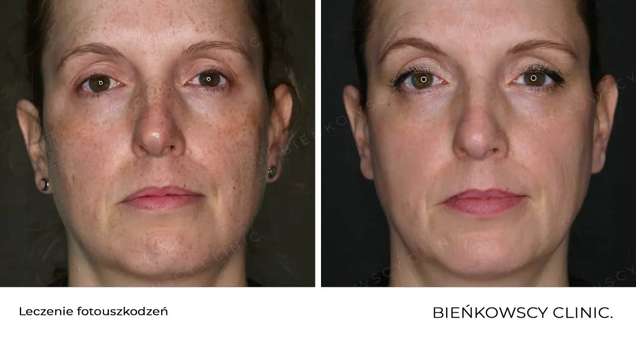 Jak pozbyć się przebarwień? Przewodnik do jednolitej cery!