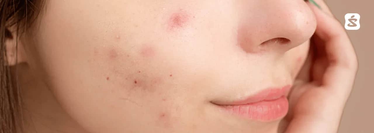 Szybkie sposoby na pryszcza: Co działa, a czego unikać?