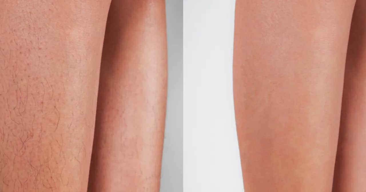 Golenie po depilacji laserowej: Kiedy i jak dbać o skórę?