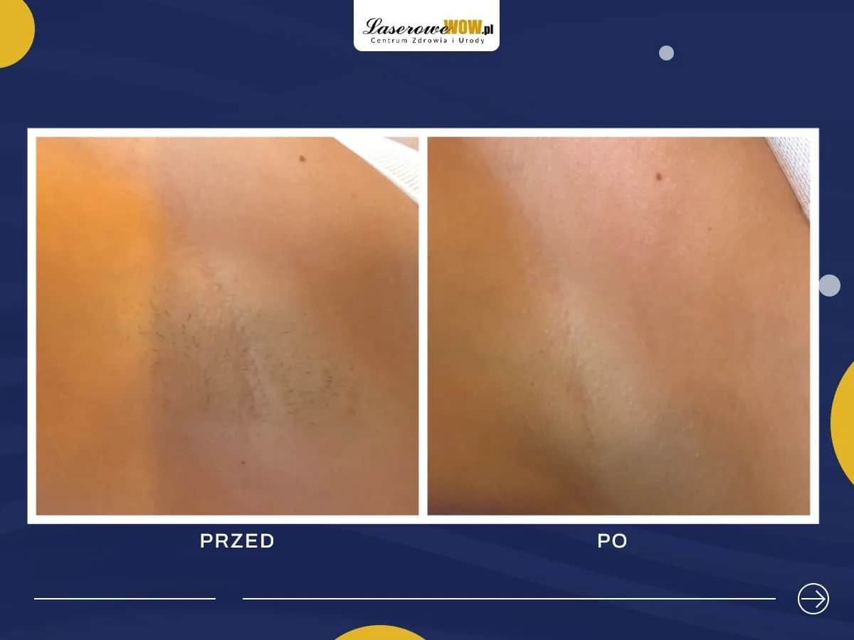 Depilacja laserowa: jak często? Ekspert radzi dla trwałych efektów