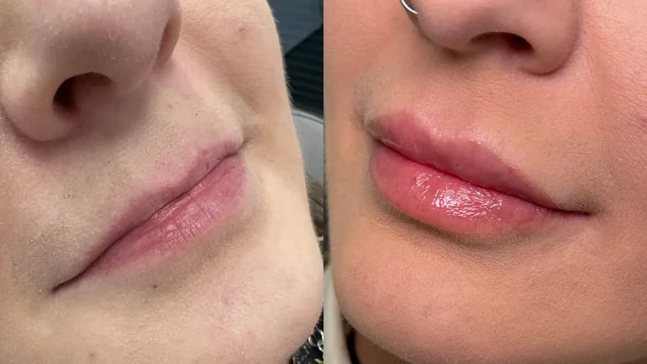 Powiększanie ust: Kwas hialuronowy, lip lift czy domowe triki?