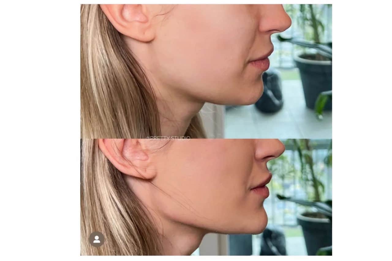 Endermologia twarzy: Lifting bez skalpela? Sprawdź efekty!